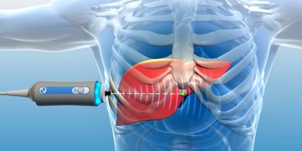 Fibroscan-o-elastografia-hepatica