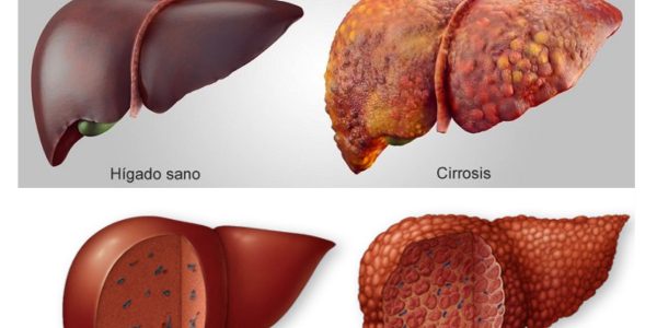 cirrosis